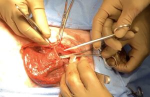 術中所見および膀胱閉鎖