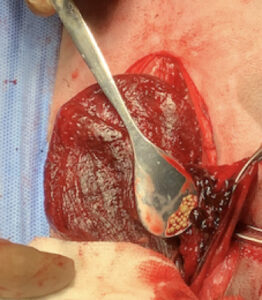 術中所見および膀胱閉鎖